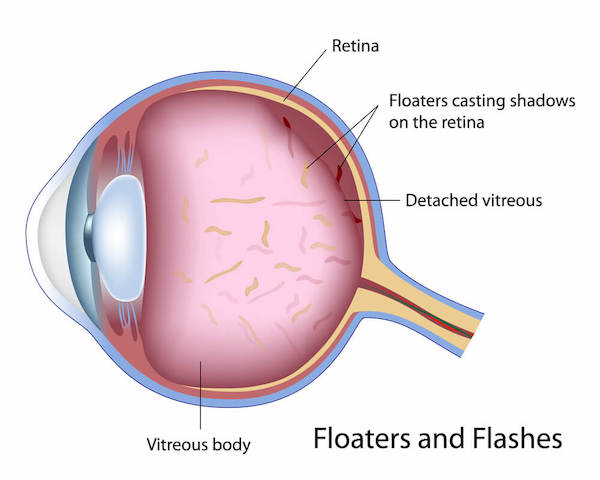 Diagram of flashes and floaters.