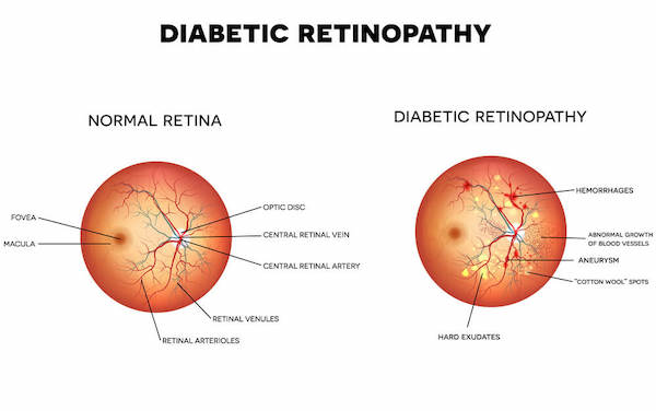 Illustrated diagram of the effects of diabetic retinopathy